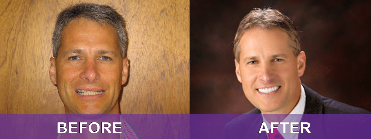 Dental Implants Before and After