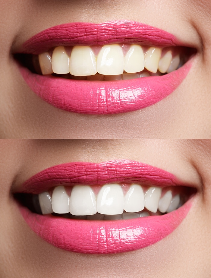 Woman teeth before and after whitening