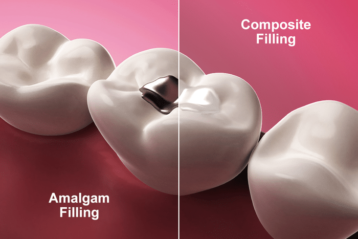 A tooth-colored filling can repair your tooth while retaining a natural-looking appearance.