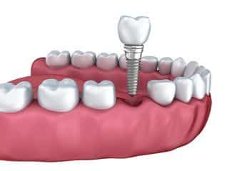 implants