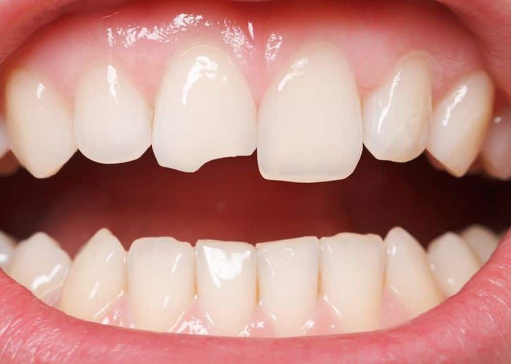 Dental bonding can repair minor damage like chipped or cracked teeth.