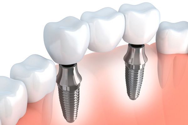 Dental implants anchored into gums