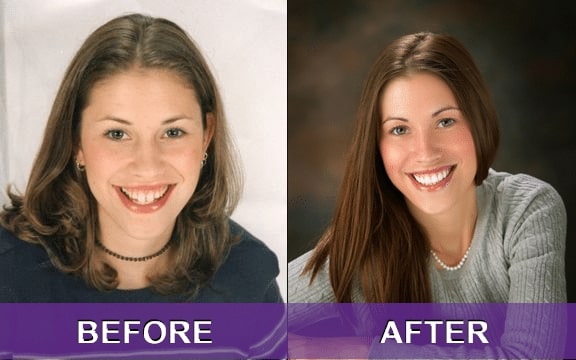 smile makeover